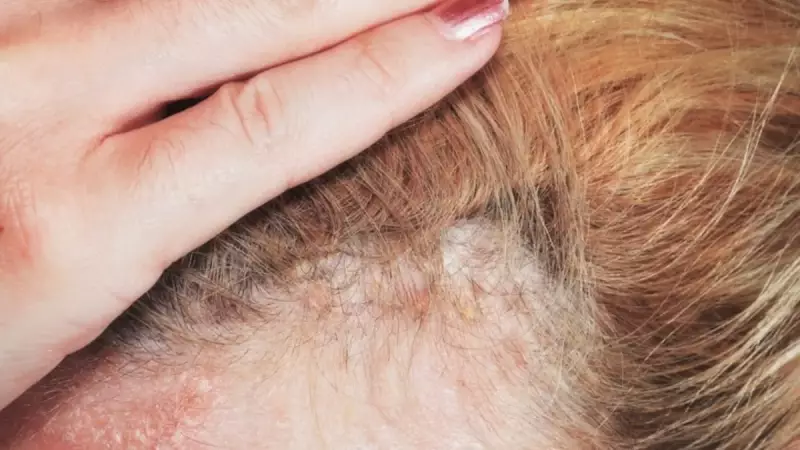 Egzamaya ve Kepeğe Son! Bu Doğal Mucize Saçları 1 Ayda 5 cm Uzatıyor