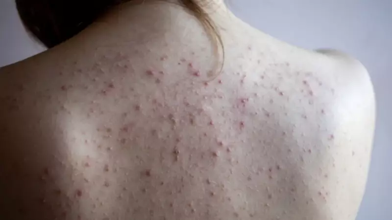 Sırt Sivilcelerinden Kurtulmanın Sırları: Pürüzsüz Bir Cilt İçin Etkili Çözümler!