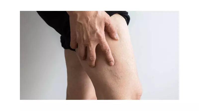 Yaz Sıcaklarında Varis Şikayetleri Artıyor: Uzmanlar Uyarıyor!