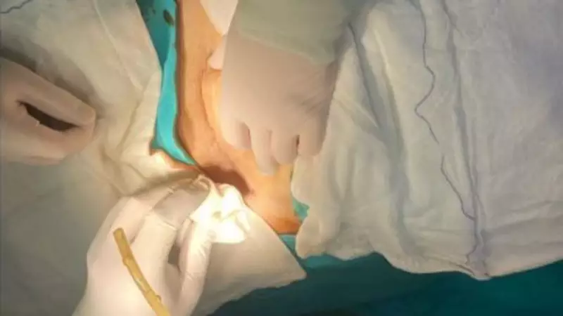 Ameliyat Sonrası Şok: Hastanın Karnında 15 cm'lik Dren Hortumu Unutuldu!