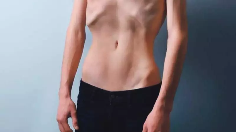 Erkeklerde Anoreksiya Alarmı: Gizli Tehlike Büyüyor!