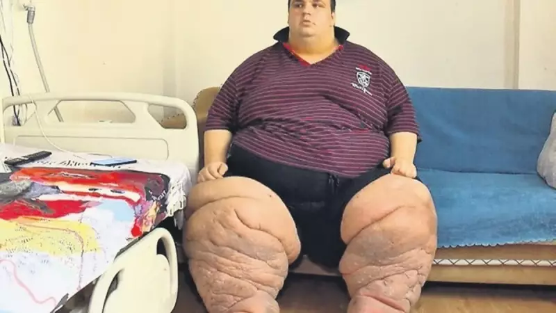 Lenfödem Hastası Mehmet'in Çığlığı: 'Yardım Edin, Artık Dayanamıyorum!'