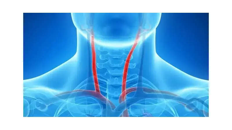 Şah Damarı Tıkanıklığı: Sessiz Tehlikeyi Tanıyın! Belirtiler ve Erken Teşhis Yöntemleri