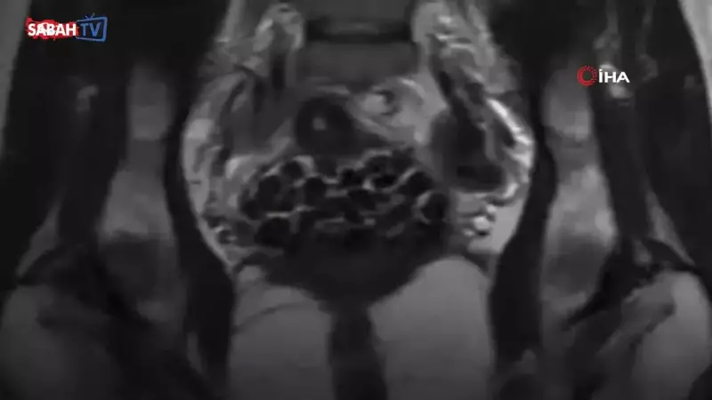 Doktorlar Bile Şoke Oldu! Bir Hastadan 287 Taş Çıktı - Tıp Literatürüne Geçecek Vaka