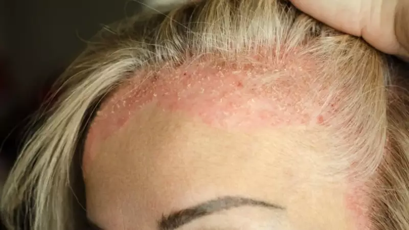 Saç Derisindeki Egzama ve Kepeğe Tek Damla ile Veda! Bu Doğal Mucize Her Derde Deva Oluyor