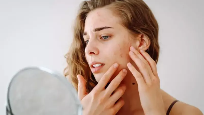 Sivilceyle Mücadelede Kapsamlı Rehber: Ergenlikten Yetişkinliğe Tüm Sivilce Türleri ve Çözümleri