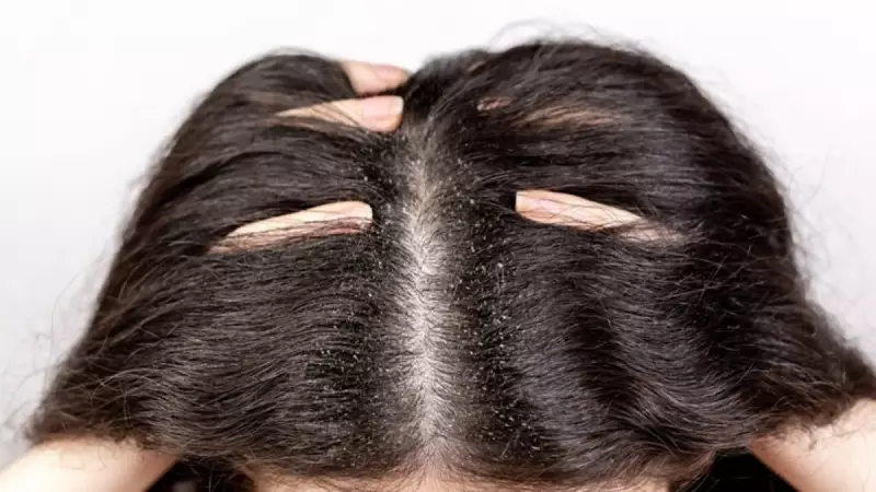 Saç Derisindeki Yağlanma ve Kepeğe 20 Dakikada Çözüm! Bu Doğal Yöntem Mucize Yaratıyor