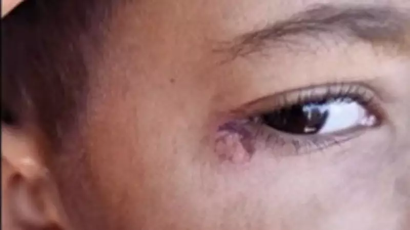 Şanlıurfa'da Akıl Almaz İşkence: Öğrencinin Yüzünde Sigara Söndürdüler!