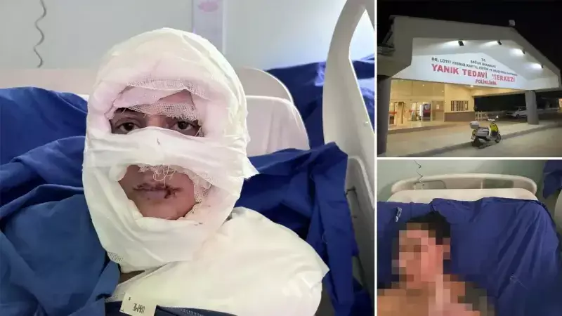 Kadıköy'de Kadın, Yanıcı Madde ile Yakılarak Ağır Yaralandı