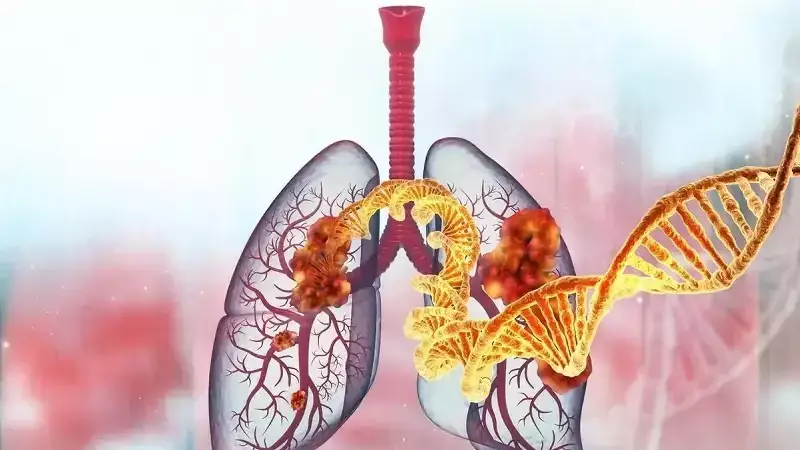 Türk Bilim İnsanlarından Akciğer Kanseri Tedavisinde Çığır Açan Keşif: Radyoterapi Yanıtını Belirleyen 12 Gen Bulundu!