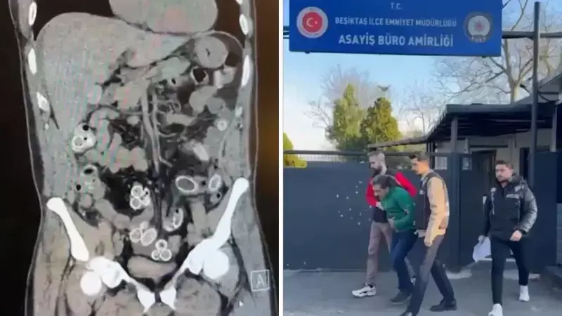 Fas'tan Gelen Şüphelinin Bağırsaklarından 49 Esrar Kapsülü Çıkarıldı