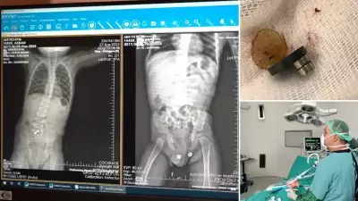 Batman'da Mıknatıs Yutan Çocuğun Bağırsakları Delindi: 3 Noktada Ameliyat
