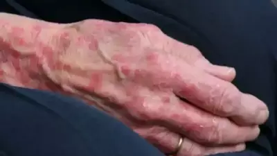 Romanya'da 44 Yıl Sonra İlk Kez Cüzzam Vakası: 2 Masöz Hastalığa Yakalandı