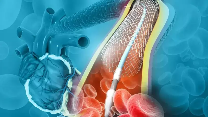 İlaçlı Koroner Balon Tedavisi: Stent Alternatifi Modern Yöntem