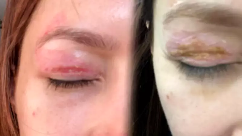 Güzellik Salonu Kabusu: Plazma Pen İşlemi Bir Gözün Kapanmasına Neden Oldu