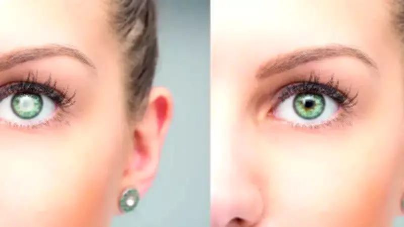 Gençlerde Katarakt Artıyor: Genetik ve Çağın Hastalıkları Tetikliyor