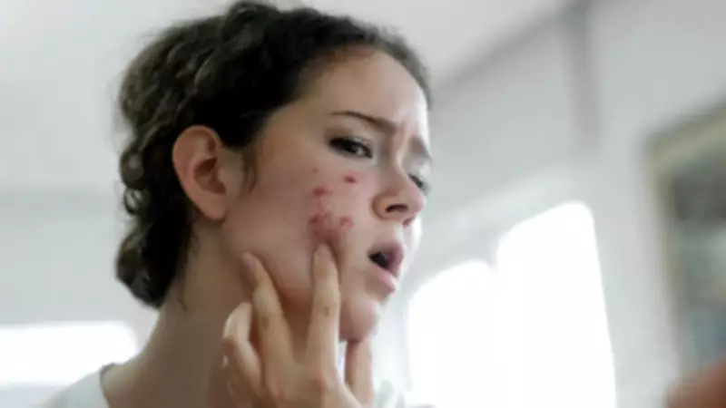 Çikolata ve Sivilce İlişkisi: Bilimsel Gerçekler Anne Sözlerini Yerle Bir Ediyor