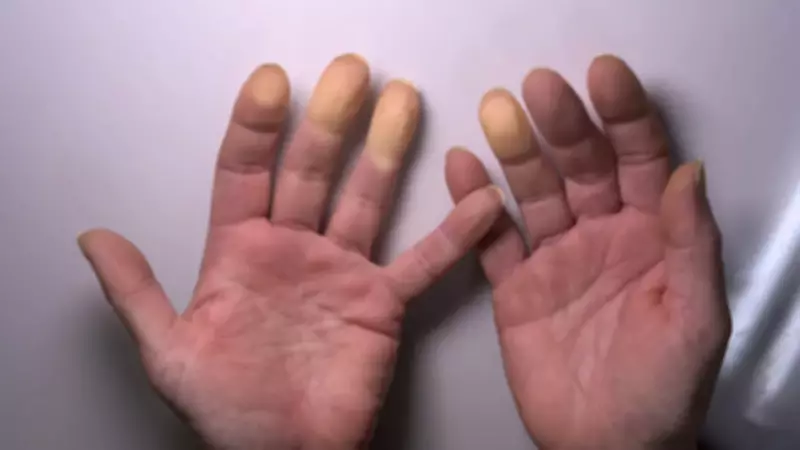 Soğukta Parmak Morarması Raynaud Hastalığına İşaret Edebilir
