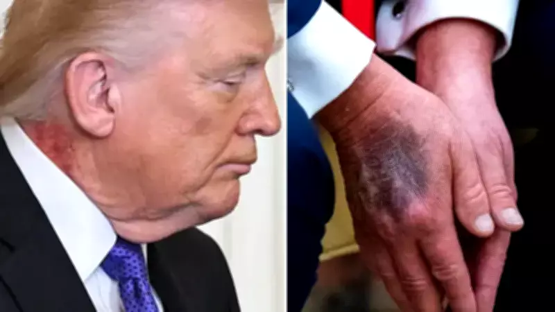 Trump'ın Boynundaki Kırmızı İz, Sağlık Tartışmalarını Alevlendirdi