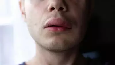 Herediter Anjioödem Hastalığında Türkiye'de 1500'e Yakın Kayıtlı Hasta Bulunuyor