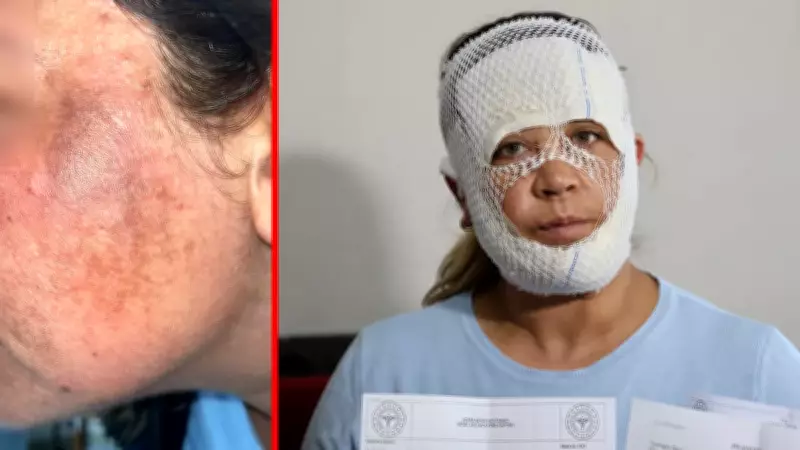 Adana'da Prenses Cilt Bakımı Kabusu: Yanık Yüzle Eve Dönen Kadının Dramı