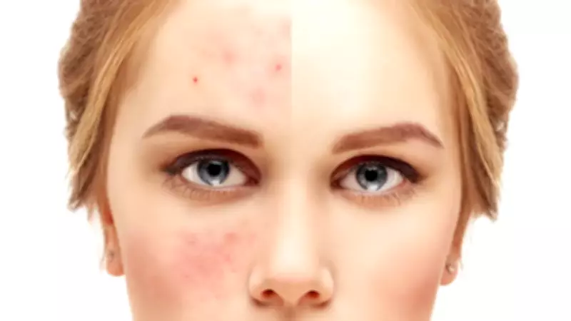 Gül Hastalığı (Rozasea) Belirtileri ve Tedavisi: Uzman Uyarısı