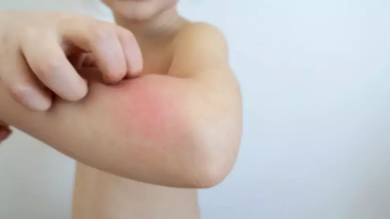 Çocuklarda Egzama Artışı: Uzman Altın Değerinde Bakım Önerileri Açıkladı