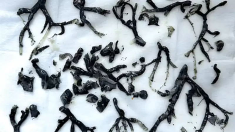 Röntgeni gören doktorlar şaşkına döndü: Akciğerlerinden ağaç dalları çıktı