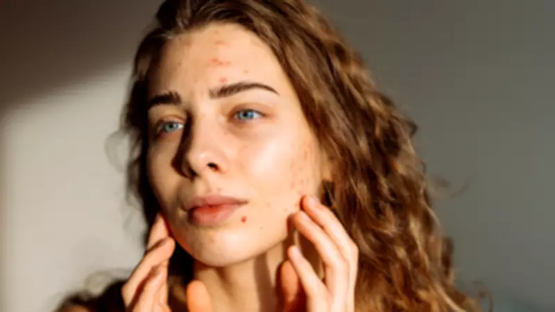Sivilceyi kuruturken artıran 14 hata: Ani akne artışında kaçının