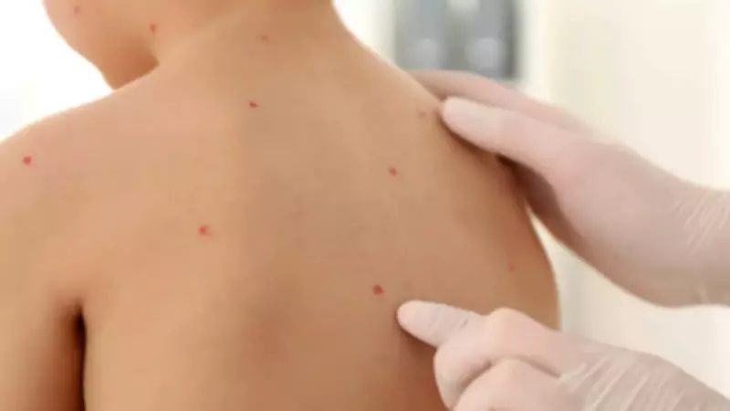 Suçiçeği Alarmı: Okul ve Kreşlerde Vakalar Artıyor, Uzmanlar Kritik Uyarılarda Bulunuyor