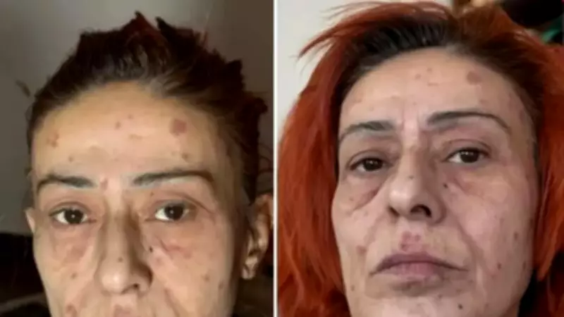 Yıldız Tilbe'nin Saç Sırrı: Alerji Sonrası Doğal 4 Malzemeli Karışım