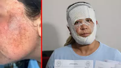 Adana'da Prenses Cilt Bakımı Kabusu: Yanık Yüzle Eve Dönen Kadının Dramı