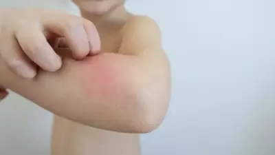 Çocuklarda Egzama Artışı: Uzman Altın Değerinde Bakım Önerileri Açıkladı