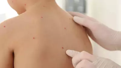 Suçiçeği Alarmı: Okul ve Kreşlerde Vakalar Artıyor, Uzmanlar Kritik Uyarılarda Bulunuyor