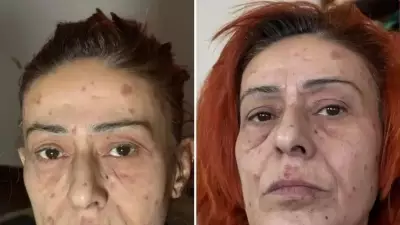 Yıldız Tilbe'nin Saç Sırrı: Alerji Sonrası Doğal 4 Malzemeli Karışım