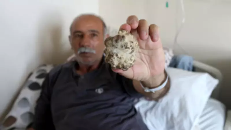 Böbrek Ağrısından Kurtuldu: Mesanesinden Elma Büyüklüğünde Taş Çıktı