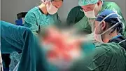Sivas'ta 77 yaşındaki hastanın göğsünden 7 kilo 750 gramlık tümör çıkarıldı