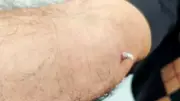 Kolundaki yara için hastaneye gitti, cilt kanseri olduğunu öğrendi