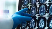 Alzheimer'a Karşı Büyük Keşif: Beyindeki Mikro Pıhtıları Tespit Eden Yeni Teknik